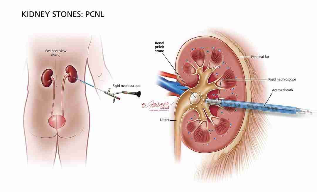 5 Symptoms of Kidney Stones You Shouldn’t Ignore